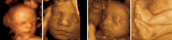 YOUR 3D 4D ULTRASOUND WILL BE PERFORMED BY DR. AYOUB